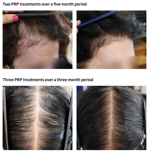 PRP_treatments.jpg