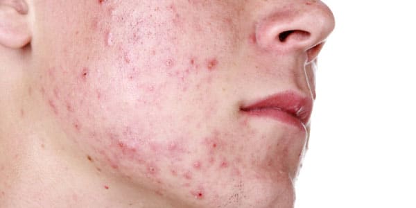 acne-scarring.jpg