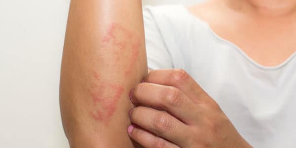 eczema.jpg