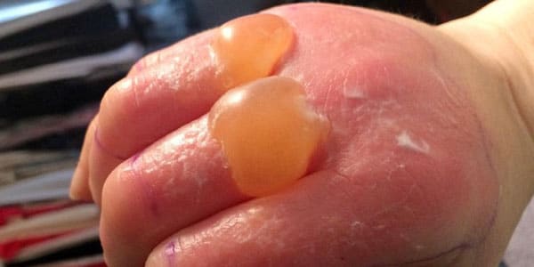blistering-diseases.jpg