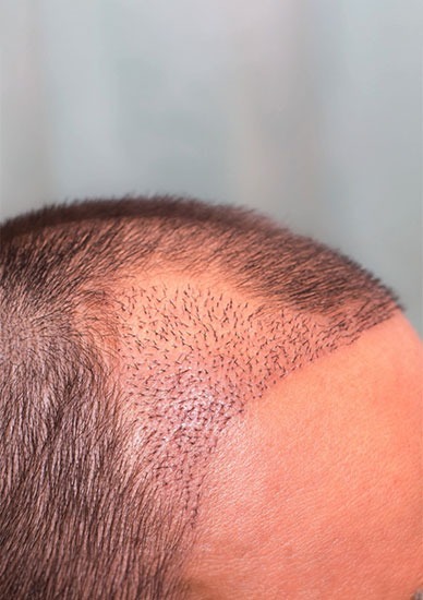 img_Hair-Transplantation.jpg