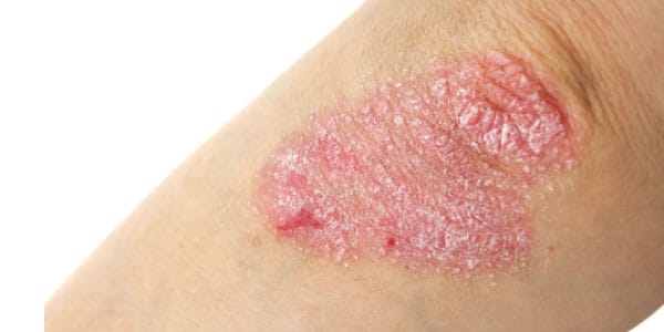 psoriasis.jpg