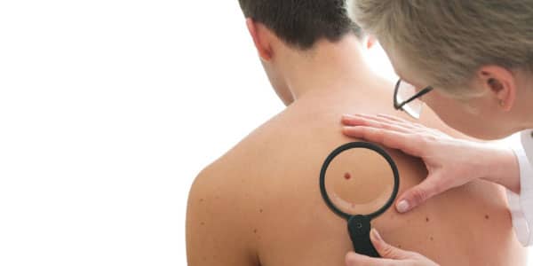 skin-cancer.jpg