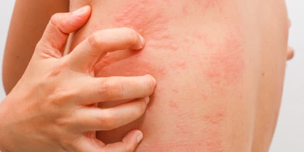 urticaria.jpg