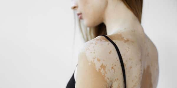 vitiligo.jpg