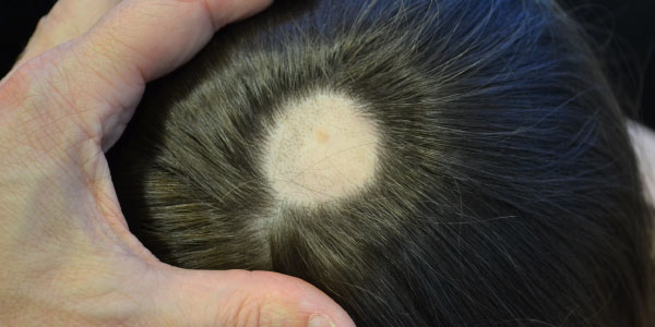 alopecia-areata.jpg